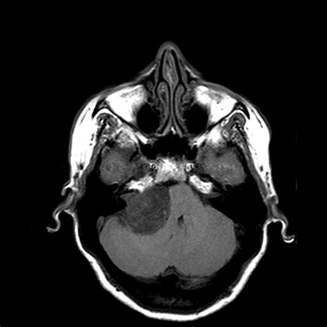 Vestibular Nerve Mri