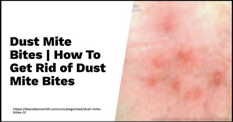 2024 Guide: Understanding Dust Mites Bites - Can They Bite & How to ...