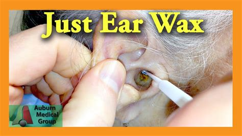 Ear Wax Removal Doctor | Auburn Medical Group - YouTube