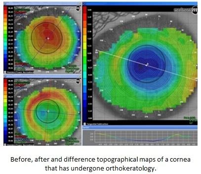 Orthokeratology – Is Ortho K the Future of Myopia Control? - My Health ...