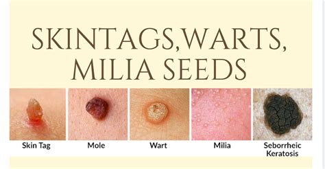 Warts Removal Treatment Delhi, Skin Wart Removal Treatment Delhi