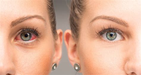 Glaucoma drops and eye redness - Laura Crawley | London Eye Surgeon