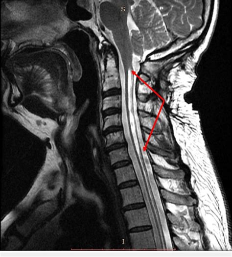 Lumbar Spine Sagittal