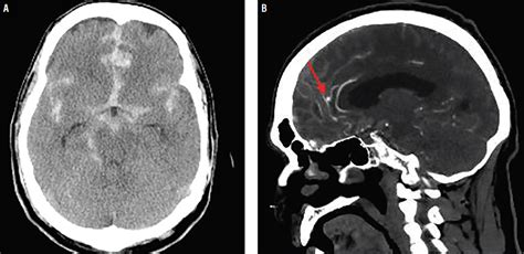 Case Report: Cerebral Aneurysm Rerupture - Practical Neurology