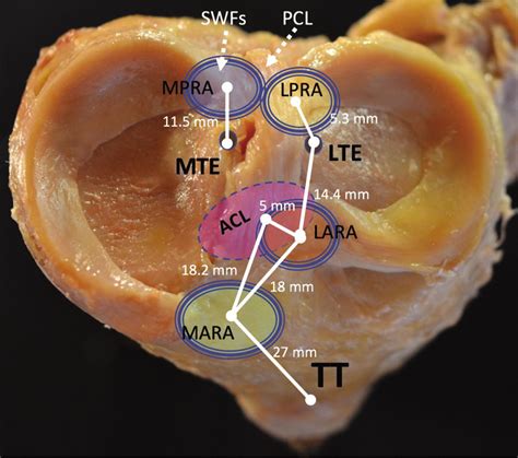 Meniscal root tears: Solving the silent epidemic - Journal of ...