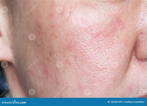 Allergy rash on the face stock image. Image of cheek - 165261493