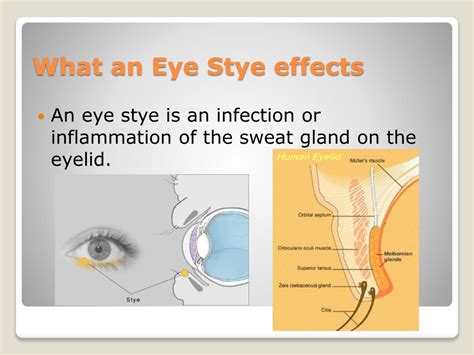 PPT - Eye Stye PowerPoint Presentation, free download - ID:2049097