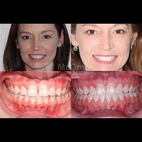 Clear Correct Aligners Patient Before and Afters - McOmie Dentistry ...