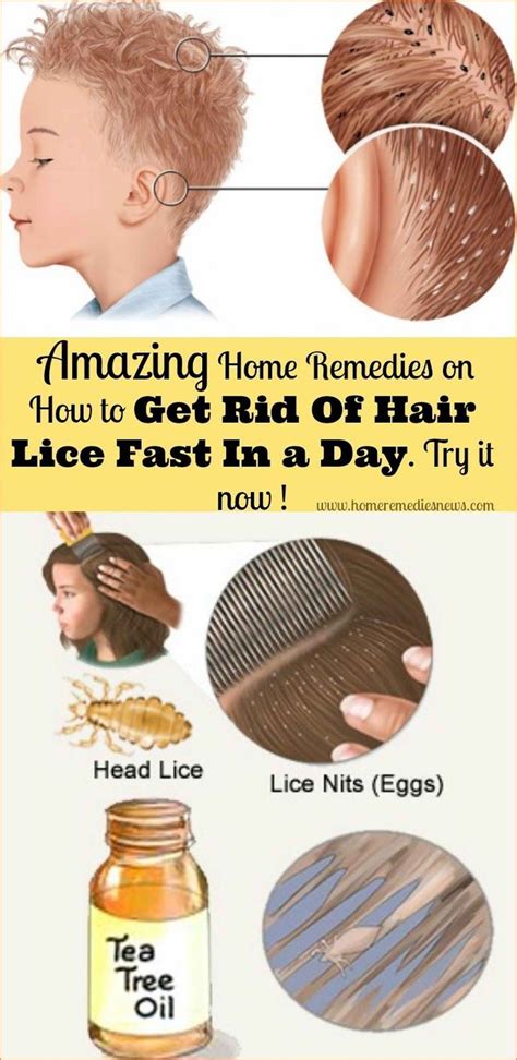 Quick Way To Get Rid Of Nits - Just For Guide