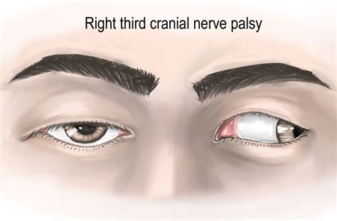 Cranial Nerve 3 Palsy