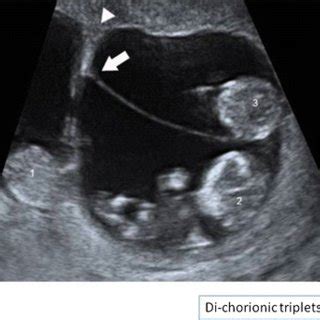 a Monochorionic-monoamniotic twins (MCMA, shown in the top image) have ...