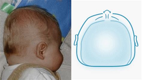 Plagiocephaly vs Brachycephaly | The Key Differences