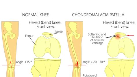 Chondromalacia Patella | Chondrosis of the Knee