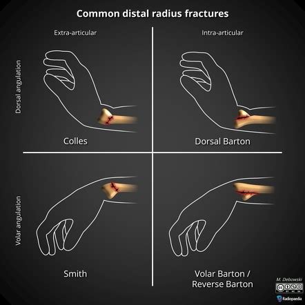 Distal Radial Fracture Classification