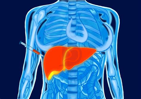 Learn About The Liver Biopsy & Its Procedure - The GI Docs