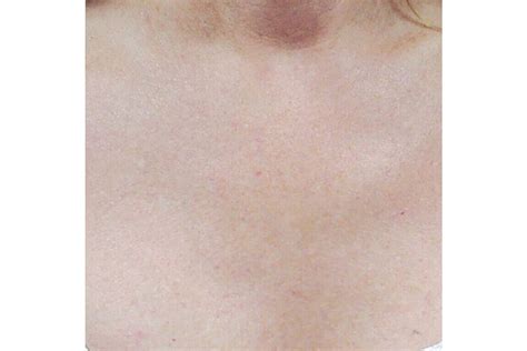 Laser Treatment for Hyperpigmentation | Javivo Clinic