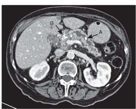 Internal Medicine: Pathophysiology of Chronic Pancreatitis