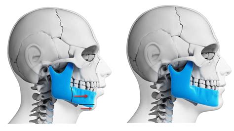 Corrective Jaw Surgery (Orthognathic Surgery) - Larry M. Wolford, DMD