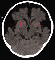 Posterior Cortical Atrophy