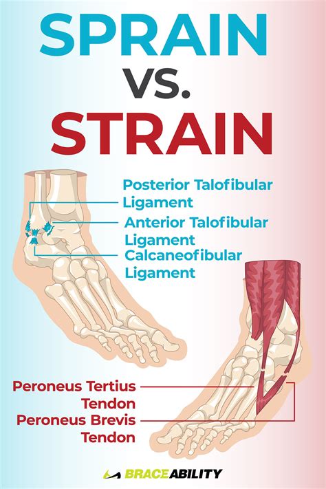 Treating a sprained ankle – Artofit