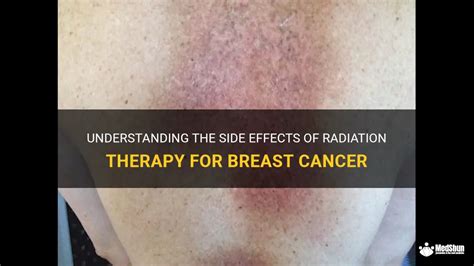 Understanding The Side Effects Of Radiation Therapy For Breast Cancer ...