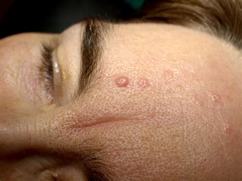 Seborrheic dermatitis treatment at home | General center | SteadyHealth.com