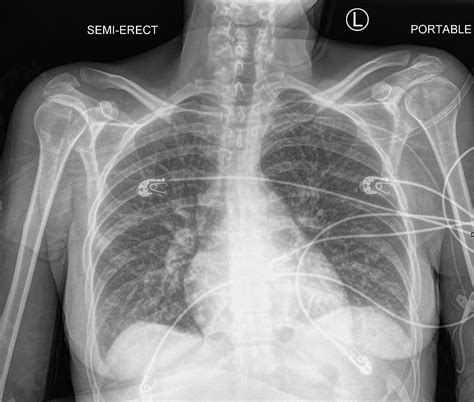 Chest X-ray and Heart Failure, CXR and CHF | Heart