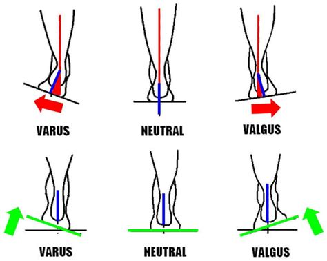 Valgus Vs Varus Of Ankle