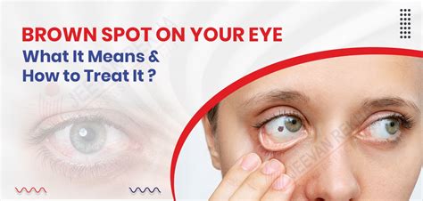 Brown Spot on Your Eye: What It Means and How to Treat It