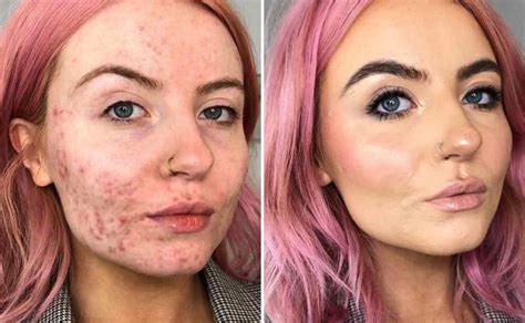 Before and After Makeup For Acne Skin