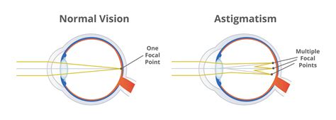 LenSx Laser and Astigmatism | Eye Care Professionals