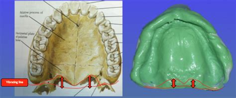 Posterior Palatal Seal Flashcards | Quizlet