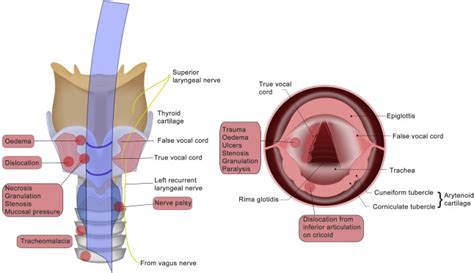 Anterior Larynx Difficult Intubation