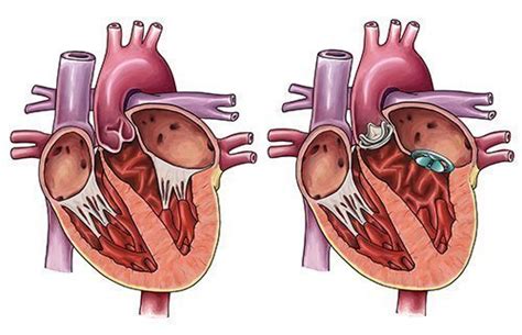 Heart Valve Replacement Surgery Cost in India | Heart Valve Surgery