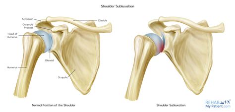 Shoulder Subluxation | Rehab My Patient