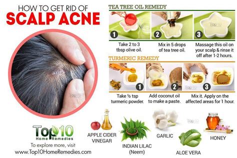 How to Get Rid of Scalp Acne | Scalp acne, Cystic acne remedies, Diy ...