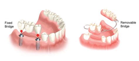 Fixed Bridges - Kye Dental