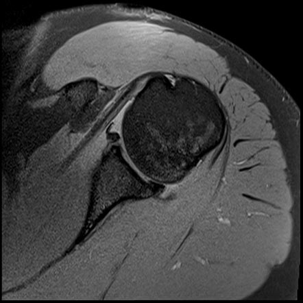 Normal shoulder MRI arthrogram | Image | Radiopaedia.org