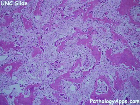 osteoblastoma bone histology