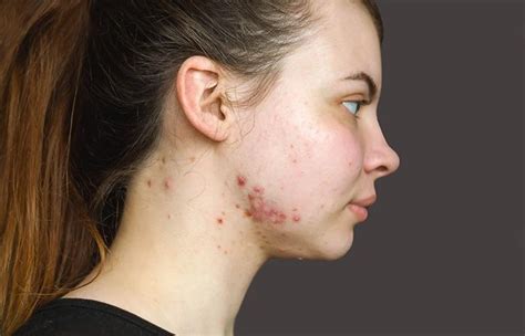 Nodular Acne: Causes, Treatment, Home Remedies And Prevention Zwivel ...