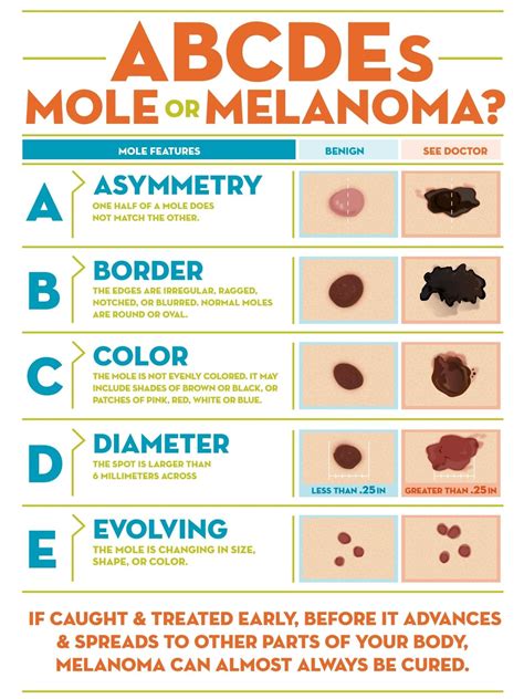 What is Melanoma? Learn the ABCDE of Moles