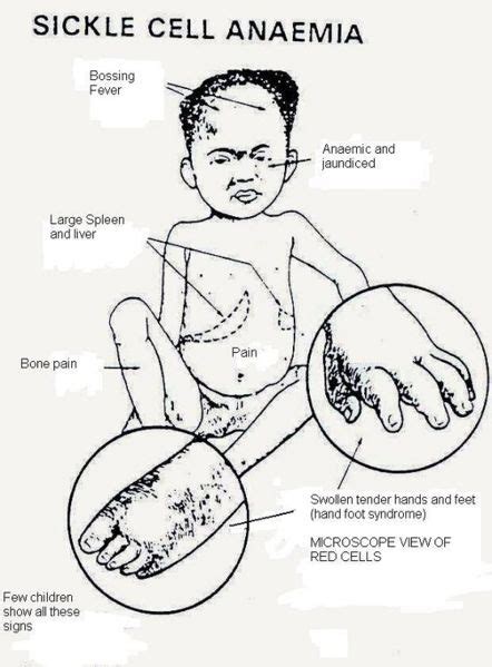 Symptoms - Sickle Cell Anemia