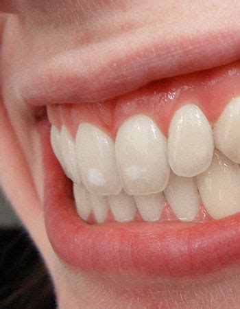 White Spots on Teeth: Causes and Treatment - Tenniswood Dental Associates