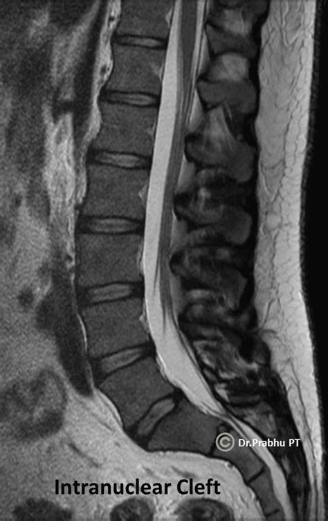 How to identify Normal Nucleus & Annulus in MRI of IVD? – Digital Teaching