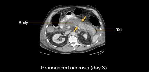 Abdominal CT: necrotizing pancreatitis • LITFL • Radiology Library