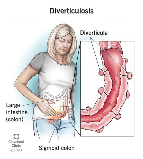 Últimas Que Es Diverticular Del Colon - Pregunteme