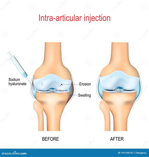 Hyaluronic Acid Injection for Knee Osteoarthritis Stock Vector ...