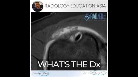 WHAT'S THE DX: SUBACROMIAL SUBDELTOID BURSITIS MRI RADIOLOGY - YouTube