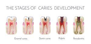 Stages of caries formation - enamel caries - dentin caries pulpitis ...