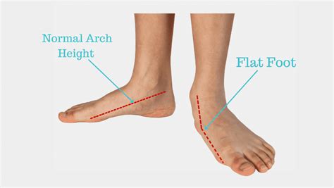 The Best Orthotics For Flat Feet Flash Sales | bellvalefarms.com